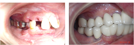 症例1治療前、治療後