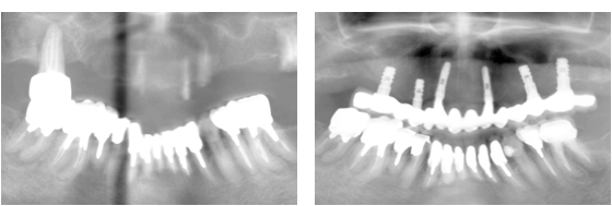 症例2レントゲン
