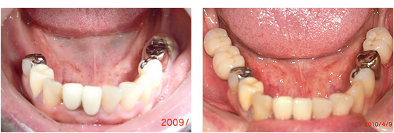 症例3治療前、治療後