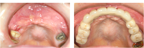 症例3治療前、治療後