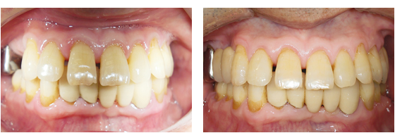 症例4治療前、治療後