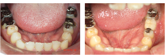 症例5治療前、治療後