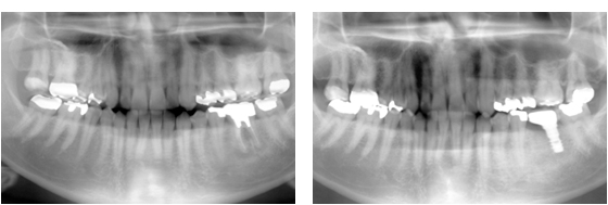 症例5レントゲン