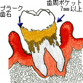 重度～末期の歯周病